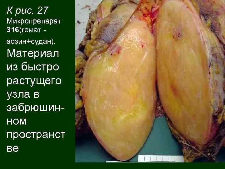 К рис. 27 Микропрепарат 316(гемат. эозин+судан). Материал из быстро растущего узла в забрюшинном пространст