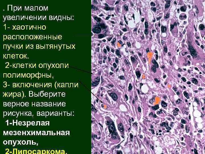 . При малом увеличении видны: 1 - хаотично расположенные пучки из вытянутых клеток. 2