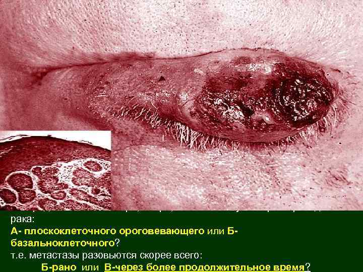 11 -Представленные макро, микро, изменения губы характерны для рака: А- плоскоклеточного ороговевающего или Ббазальноклеточного?