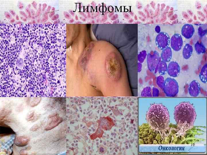 Лимфомы 10 