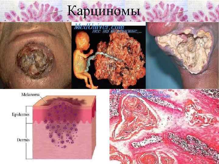 Карциномы 12 