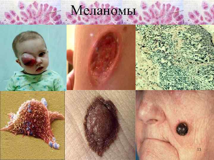 Меланомы 13 