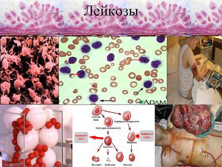 Лейкозы 15 