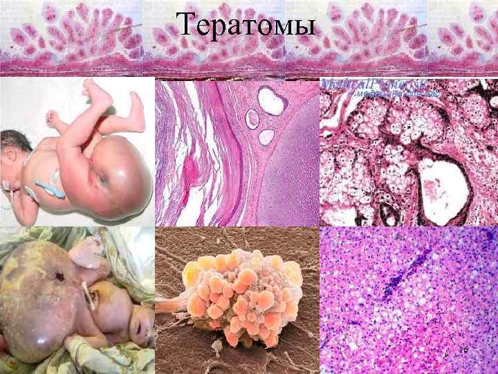 Тератомы 16 