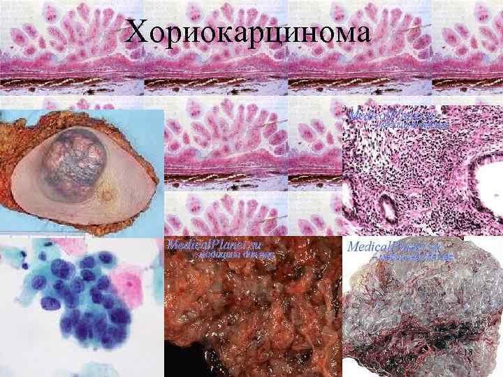 Хориокарцинома 18 