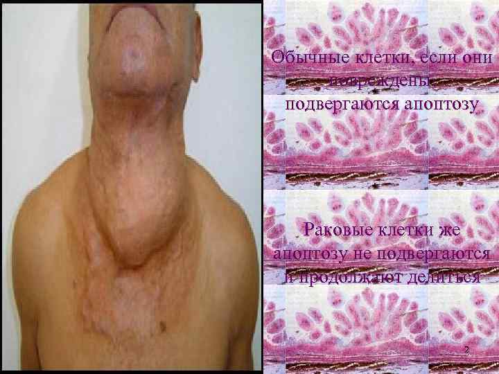 Обычные клетки, если они повреждены, подвергаются апоптозу Раковые клетки же апоптозу не подвергаются и