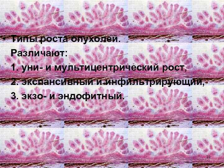  • Типы роста опухолей. Различают: 1. уни- и мультицентрический рост, 2. экспансивный и
