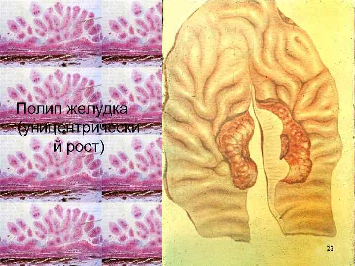 Полип желудка (уницентрически й рост) 22 