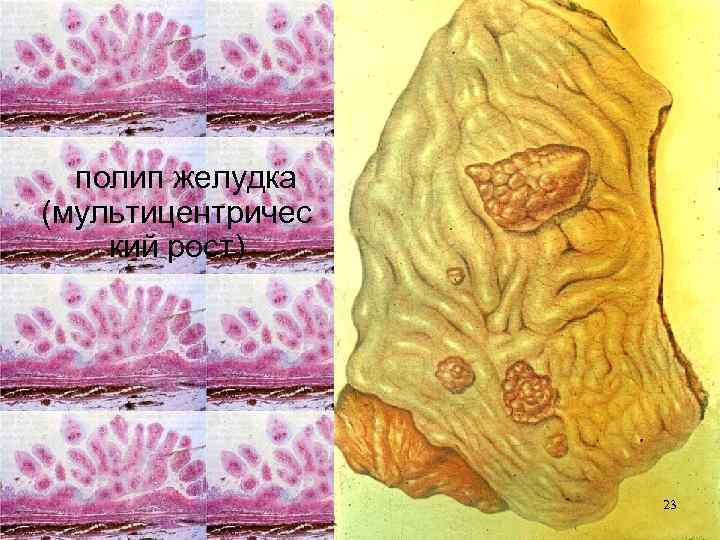 полип желудка (мультицентричес кий рост) 23 