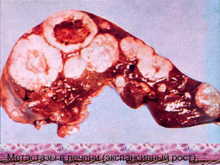 Метастазы в печени (экспансивный рост) 24 