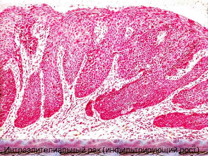 25 Интраэпителиальный рак (инфильтрирующий рост) 
