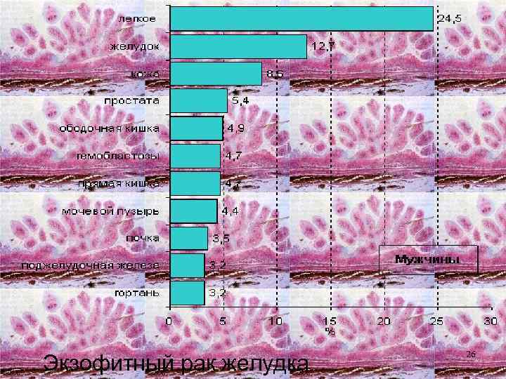 Экзофитный рак желудка 26 
