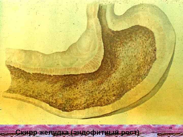 Скирр желудка (эндофитный рост) 28 