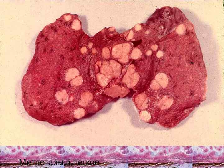 Метастазы в легкое 30 