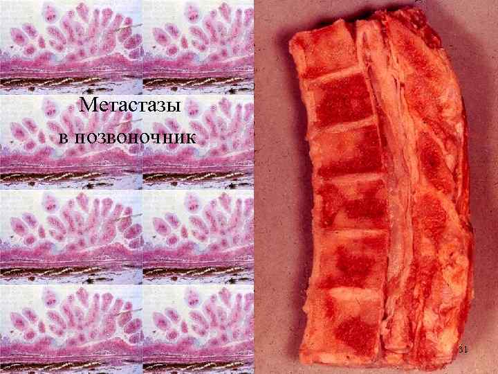 Метастазы в позвоночник 31 
