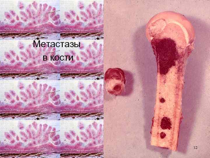 Метастазы в кости 32 
