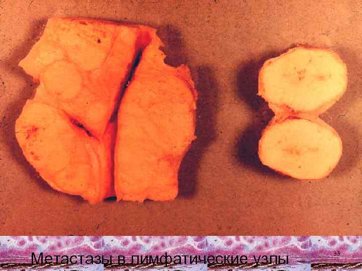 Метастазы в лимфатические узлы 33 