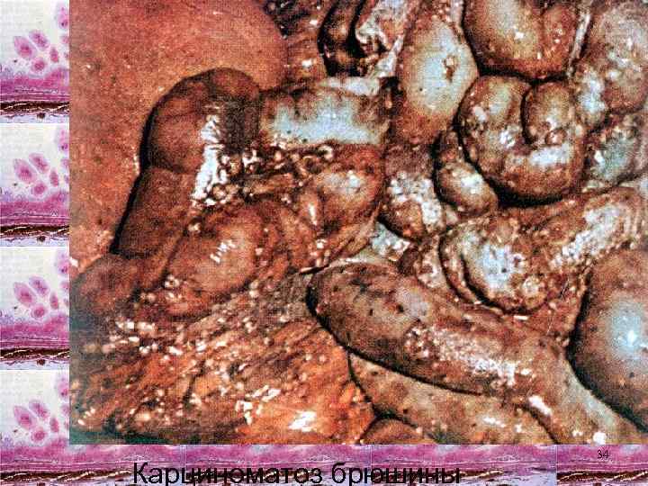 Карциноматоз брюшины 34 