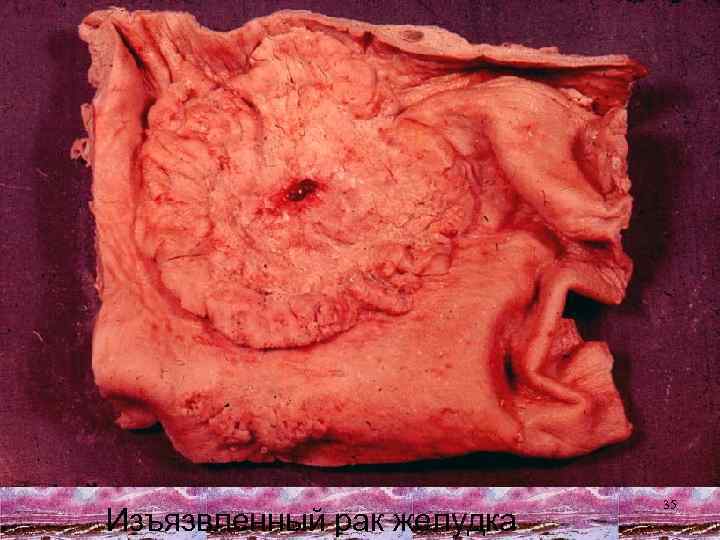 Изъязвленный рак желудка 35 