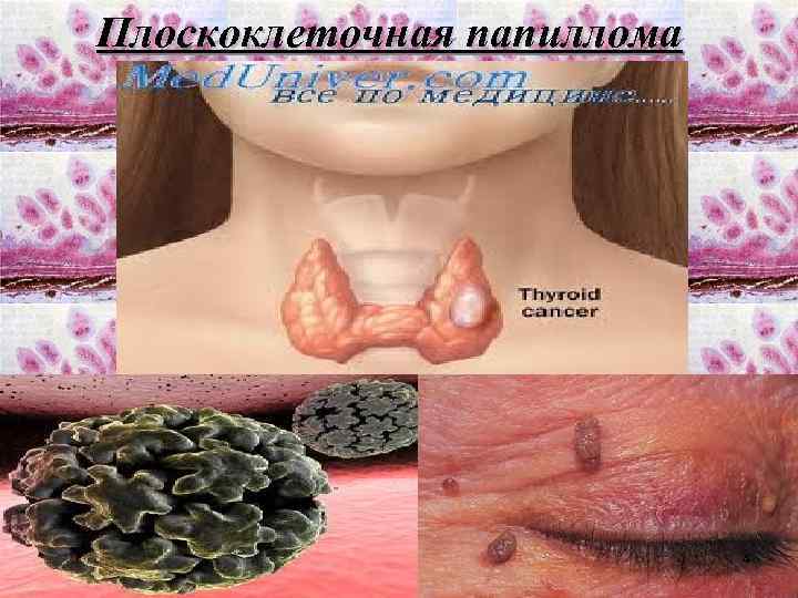 Плоскоклеточная папиллома 4 