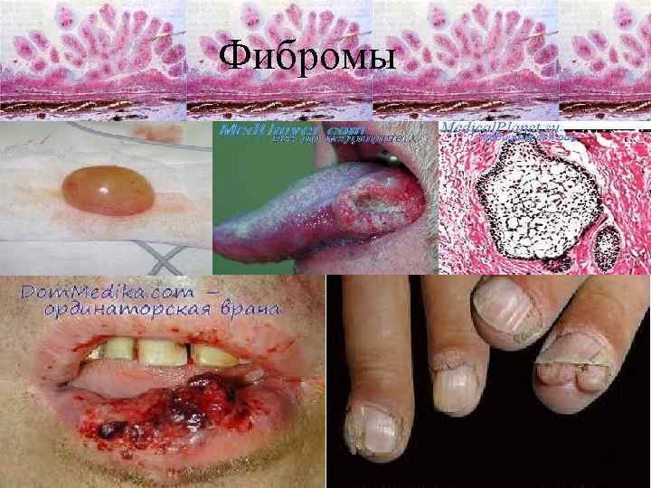 Фибромы 6 