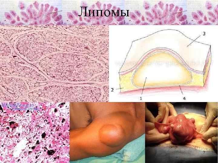 Липомы 7 