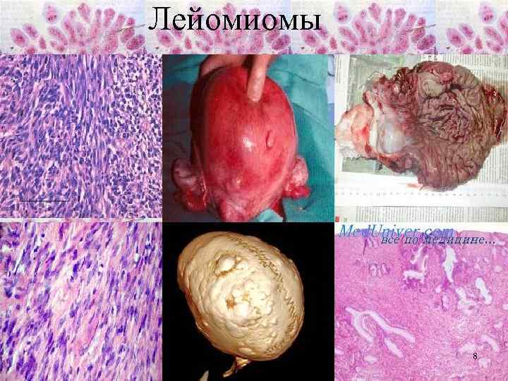 Лейомиомы 8 