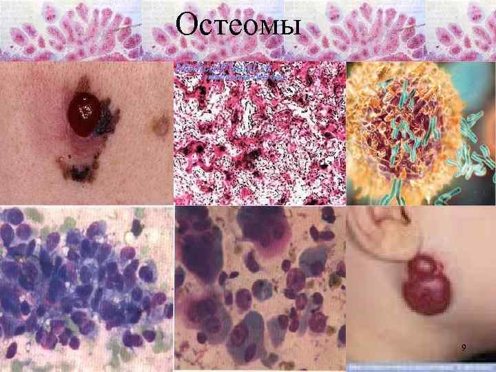 Остеомы 9 