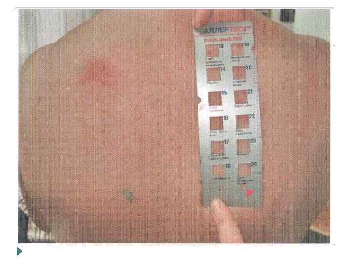 Аппликацонные пробы Исп-я для диагностики ГЗТ Применяются тест с-мы в виде пластин с аллергенами