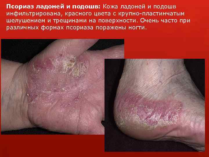 Псориаз ладоней и подошв: Кожа ладоней и подошв инфильтрирована, красного цвета с крупно-пластинчатым шелушением
