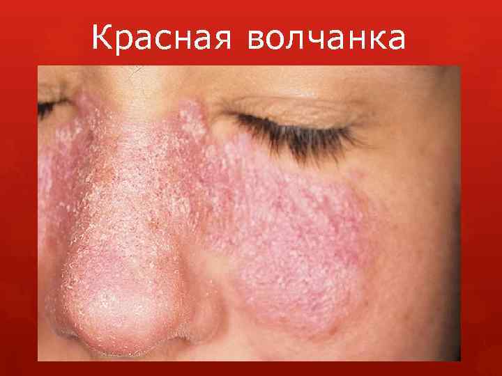 Красная волчанка 