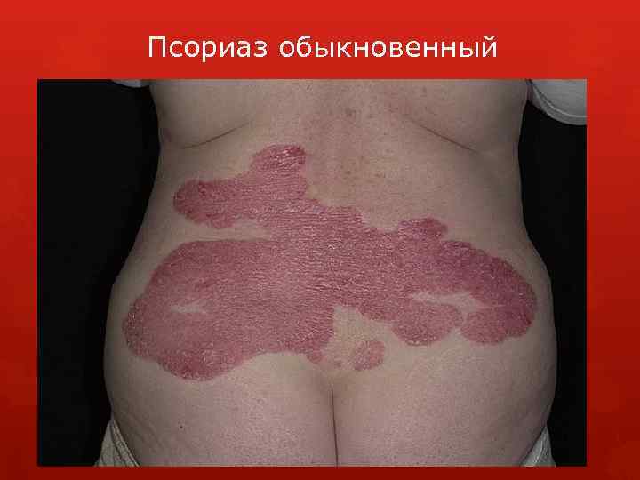 Псориаз обыкновенный 