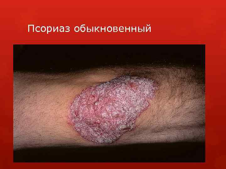 Псориаз обыкновенный 