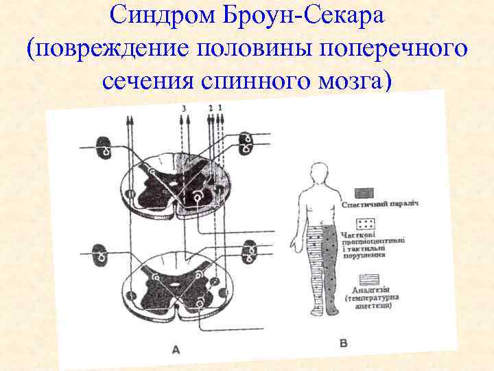 Синдром Броун Секара (повреждение половины поперечного сечения спинного мозга) 