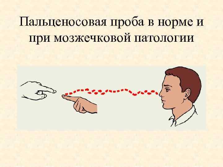 Пальценосовая проба в норме и при мозжечковой патологии 