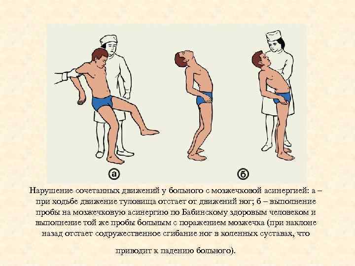 Нарушение сочетанных движений у больного с мозжечковой асинергией: а – при ходьбе движение туловища