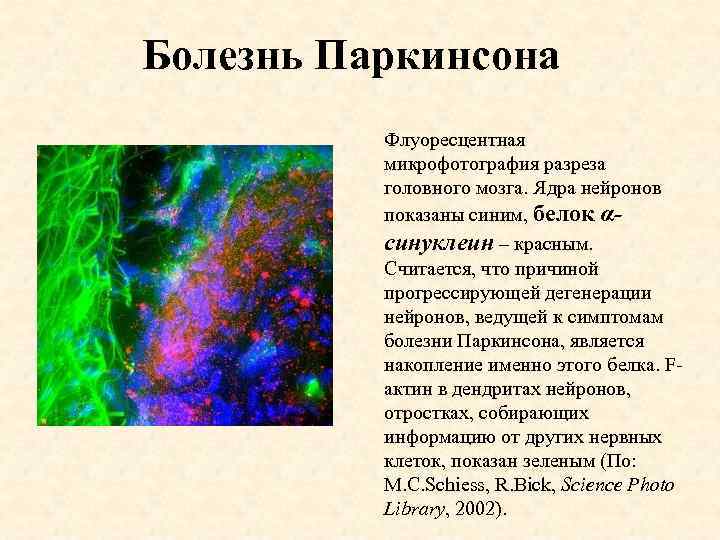 Болезнь Паркинсона Флуоресцентная микрофотография разреза головного мозга. Ядра нейронов показаны синим, белок αсинуклеин –