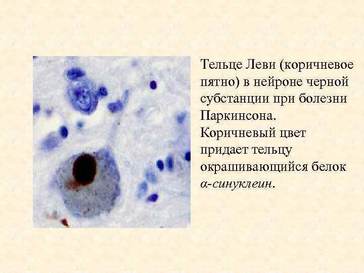 Тельце Леви (коричневое пятно) в нейроне черной субстанции при болезни Паркинсона. Коричневый цвет придает