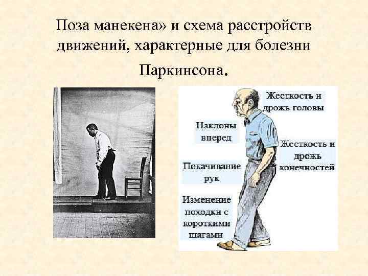Поза манекена» и схема расстройств движений, характерные для болезни Паркинсона. 