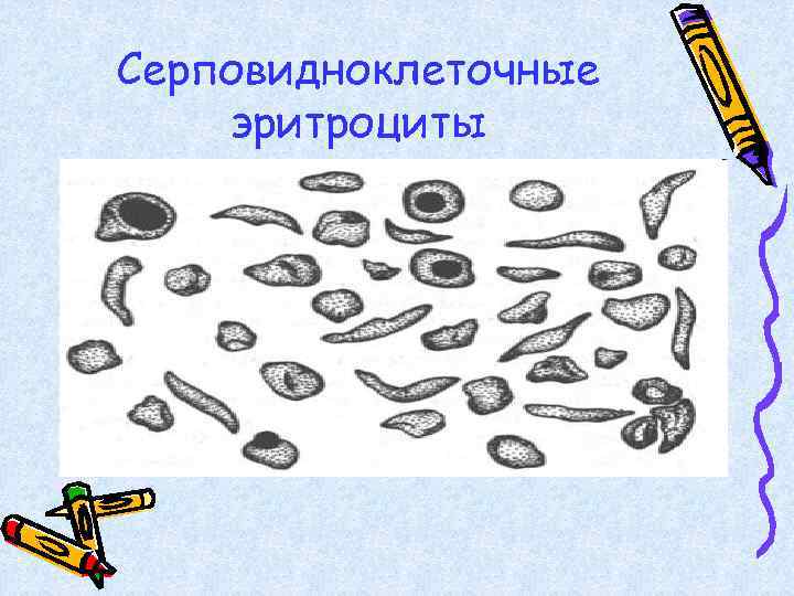 Серповидноклеточные эритроциты 