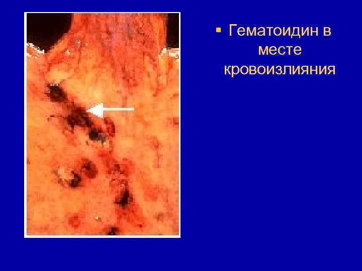 § Гематоидин в месте кровоизлияния 