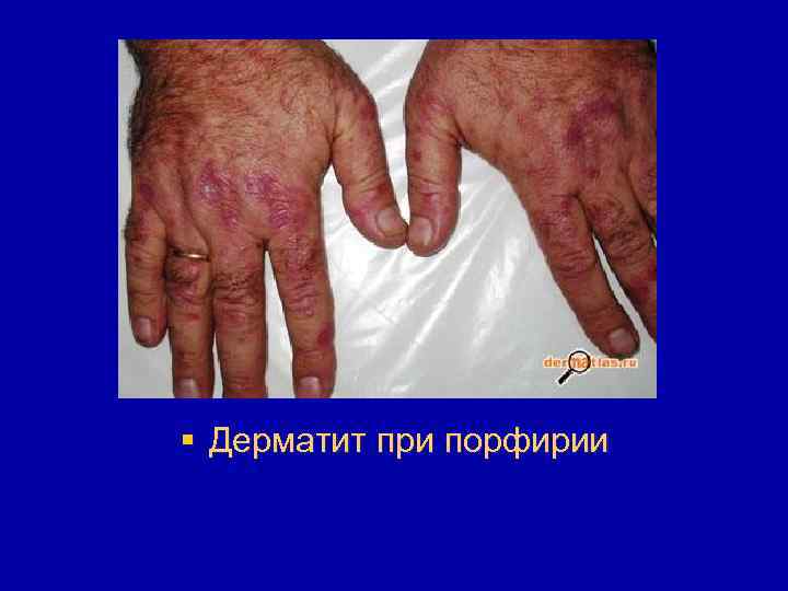 § Дерматит при порфирии 