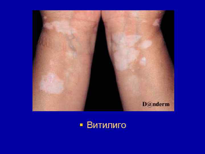 § Витилиго 