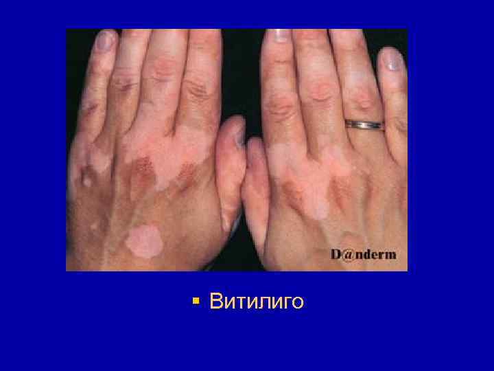 § Витилиго 