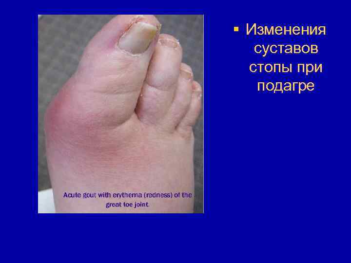 § Изменения суставов стопы при подагре 