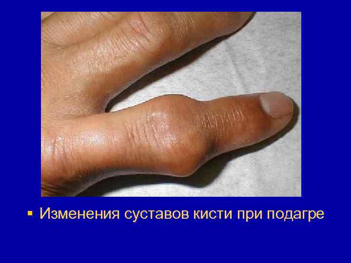 § Изменения суставов кисти при подагре 