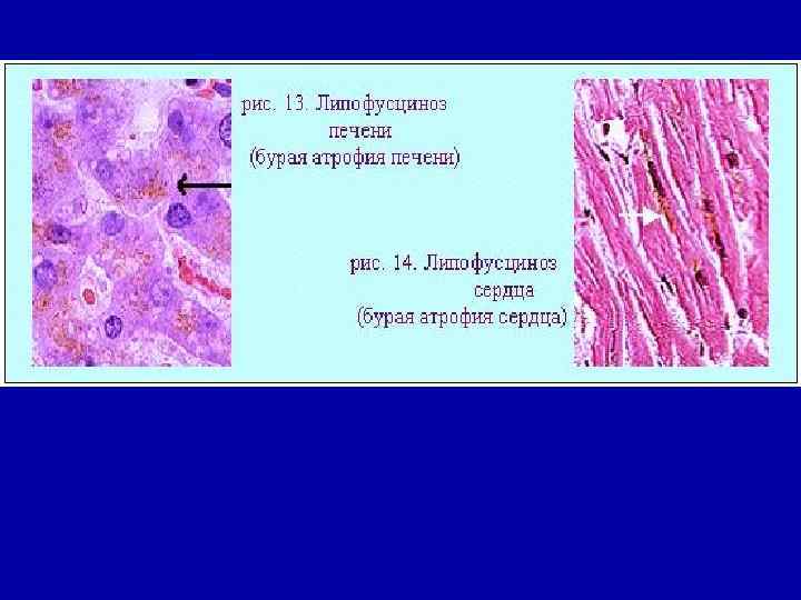 Липофусциноз. Бурая атрофия печени препарат. Бурая атрофия печени липофусциноз. Бурая атрофия печени рисунок. Бурая атрофия причины возникновения.