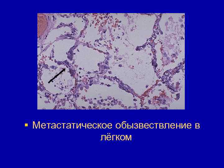 § Метастатическое обызвествление в лёгком 