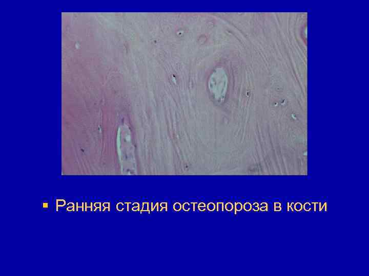 § Ранняя стадия остеопороза в кости 