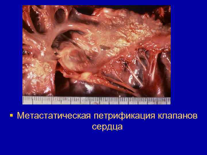 § Метастатическая петрификация клапанов сердца 